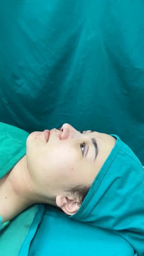Case mũi cấu trúc vừa hoàn thành