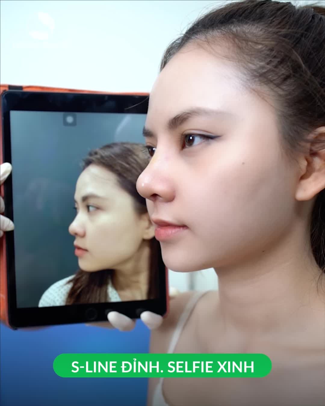 Mũi S-Line đỉnh cao Selfie xinh