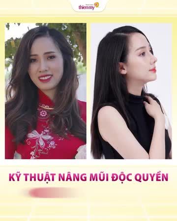 Nâng mũi cao tây không khó, nâng mũi vừa tự nhiên vừa hài hòa với gương mặt mới khó!