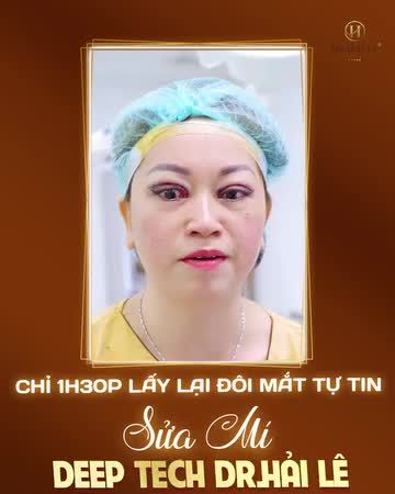 Phải làm sao để lấy lại đôi mắt rạng rỡ? -Tìm chi cho xa xôi, Sửa mí ngay hôm nay tại Dr.Hải Lê!