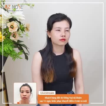 Bác sĩ CKI. Nguyễn Hoàng Nam nâng mũi cấu trúc, bọc Megaderm cho khách hàng 9X.