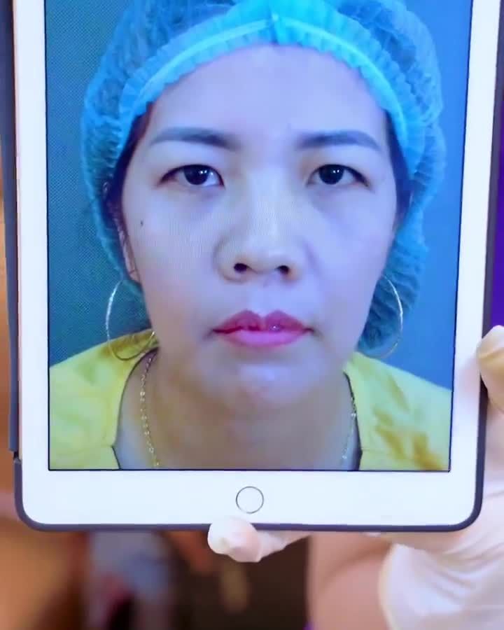 Chỉnh hình mí mắt mk sụp mí u buồn trở nên tươi trẻ rạng rỡ chỉ sau 45 phút tại Dr.Hải Lê