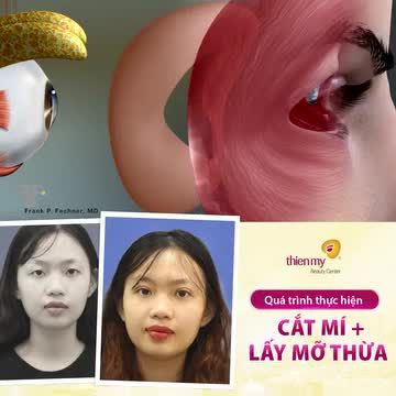 MUỐN CẮT MÍ KHÔNG SƯNG Chọn cắt mí tại Thiện Mỹ