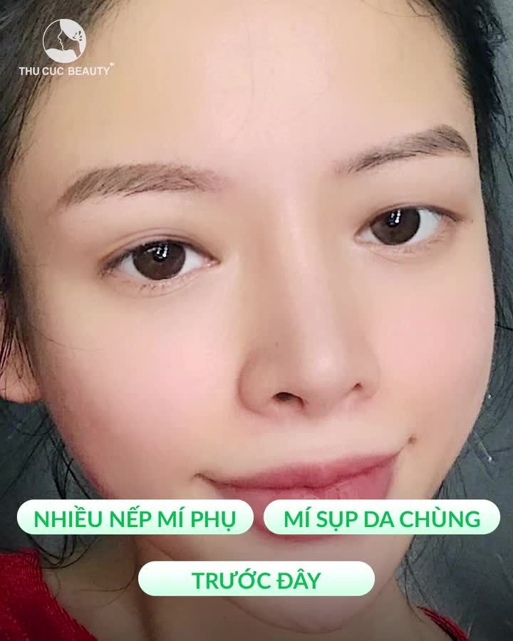 Mí bị sụp, nhiều da trùng Chọn Mắt TC