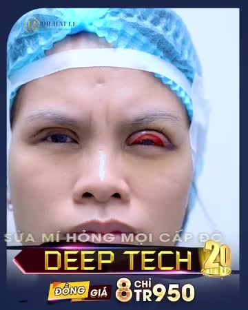 NHÂN THÁNG KỶ NIỆM 5 NĂM RA MẮT CÔNG NGHỆ DEEPTECH20 - GIẢI CỨU MỌI CA MÍ LỖI HỎNG TỪ NẶNG ĐẾN RẤT NẶNG