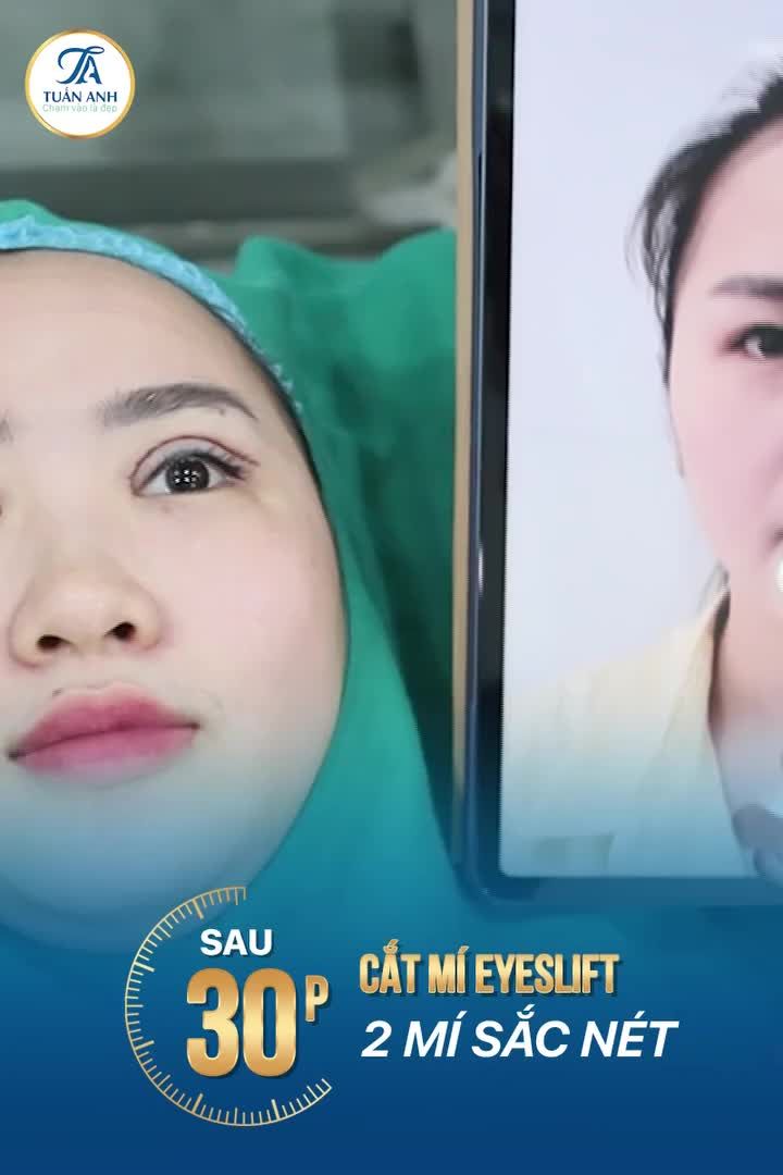 MÍ SỤP DA CHÙNG CHỌN CẮT MÍ NGAY