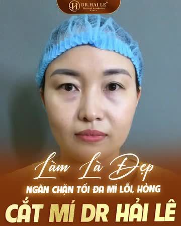 Đôi mắt 2 mí tươi xinh, sắc nét sẽ khiến người đối diện chỉ cần nhìn thôi cũng đủ mê say, "ngất ngây" không thể rời mắt!