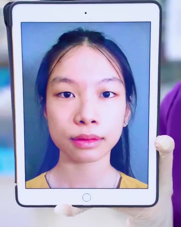 Mắt một mí hóa 2 mí chỉ sau 45 phút trông sẽ như thế nào? Theo dõi ngay