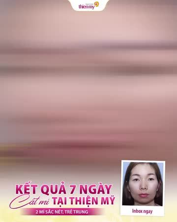 Feedback xinh “xỉu” đây! Nhìn video dưới đây là cũng biết được lý do vì sao khách hàng chọn cắt mí tại THIỆN MỸ phải không ạ?