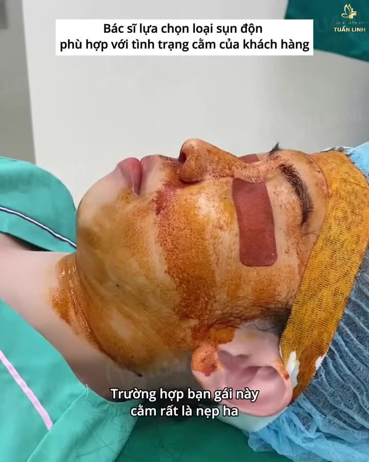 Cằm đẹp chuẩn tỉ lệ - Form dáng tự nhiên - Hợp phong thủy chỉ sau 60 phút thực hiện.