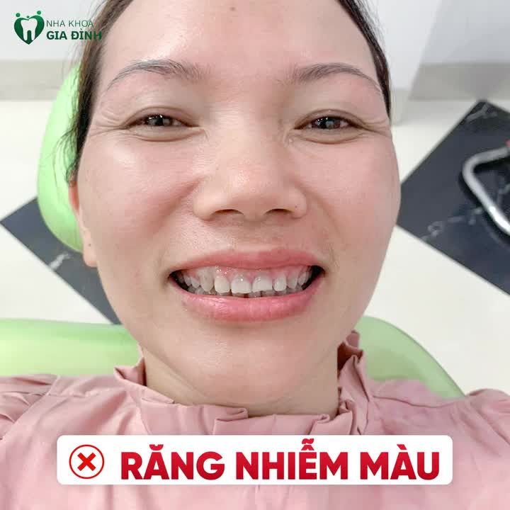 TOP 4 "MÀN LỘT XÁC" NGOẠN MỤC ĐỈNH NHẤT TẠI NHA KHOA GIA ĐÌNH