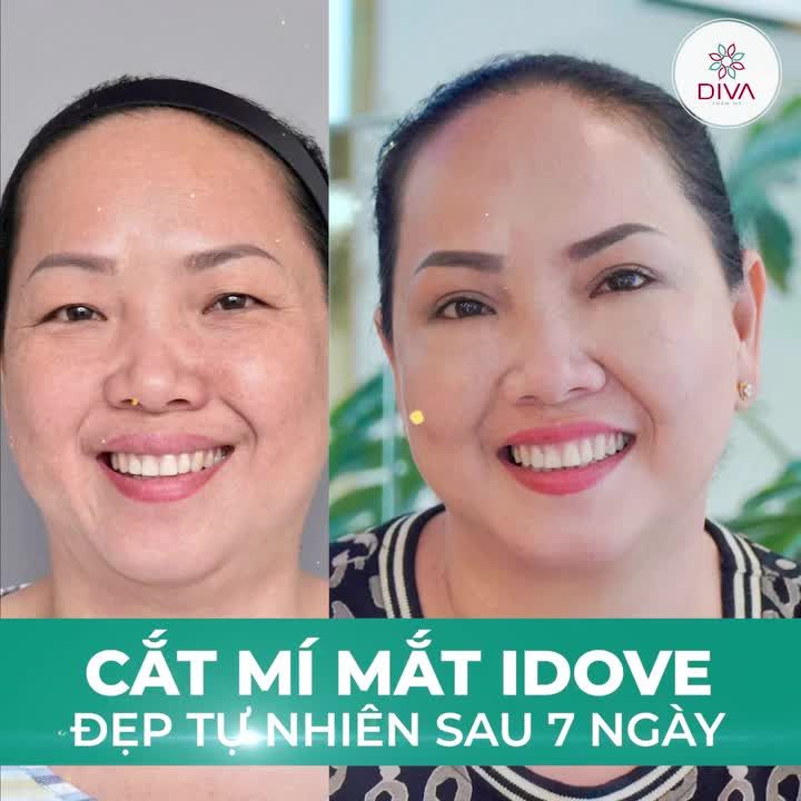 CẮT MÍ MẮT IDOVE: MÍ ĐỀU – MẮT TO CUỐN HÚT