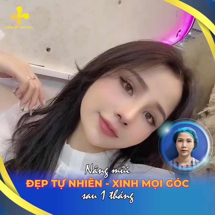 Feedback mũi đẹp tự nhiên, cân mọi góc máy sau 1 tháng.