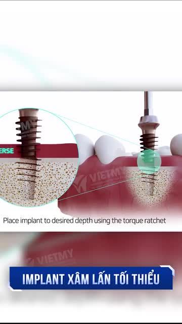 MẤT RĂNG ẢNH HƯỞNG ĐẾN SỨC KHỎE NHIỀU HƠN BẠN NGHĨ