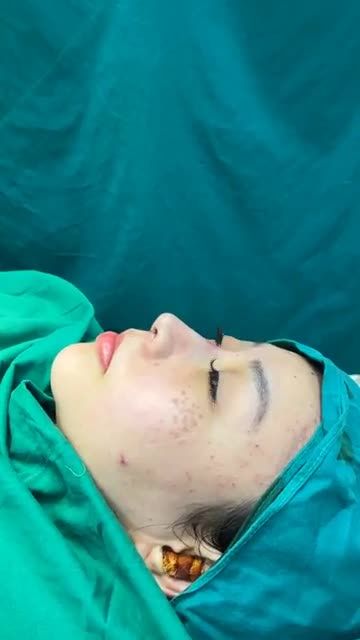 Case mũi cấu trúc sửa lại vừa hoàn thành