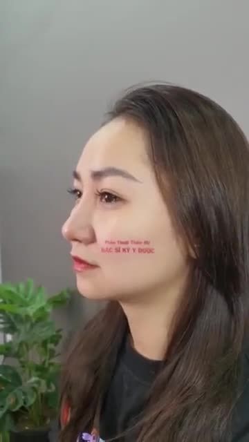 "LỘ DIỆN" NGAY DÁNG MŨI ALINE SAU 2 THÁNG THỰC HIỆN
