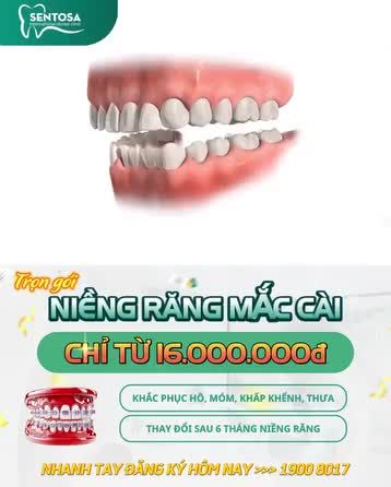 TRỌN GÓI NIỀNG RĂNG MẮC CÀI CHỈ TỪ 16.000.000Đ