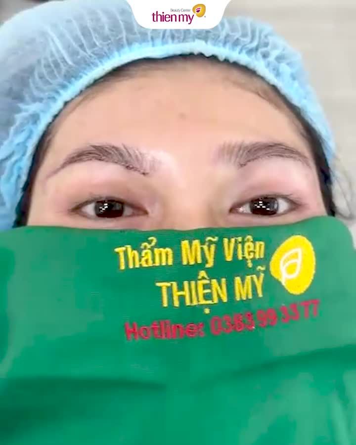 CẬN CẢNH KẾT QUẢ TREO CUNG MÀY VỪA ĐƯỢC BS. THIỆN THỰC HIỆN