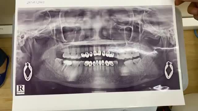 Kết quả sau nhổ răng khôn 48 và bọc sứ thẩm mỹ 16 răng cho cô Hải