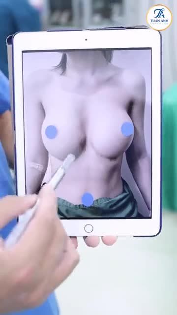 Nâng ngực cho chị khách sau lần đầu không như ý
