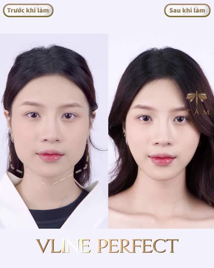 LÊN HƯƠNG NHAN SẮC - Chỉ duy nhất một lần thực hiện: THON GỌN HÀM Vline Perfect