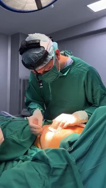 KHÁCH HÀNG SA TRỄ NGỰC ĐỘ 4 - TIẾN HÀNH PHẪU THUẬT THU GỌN