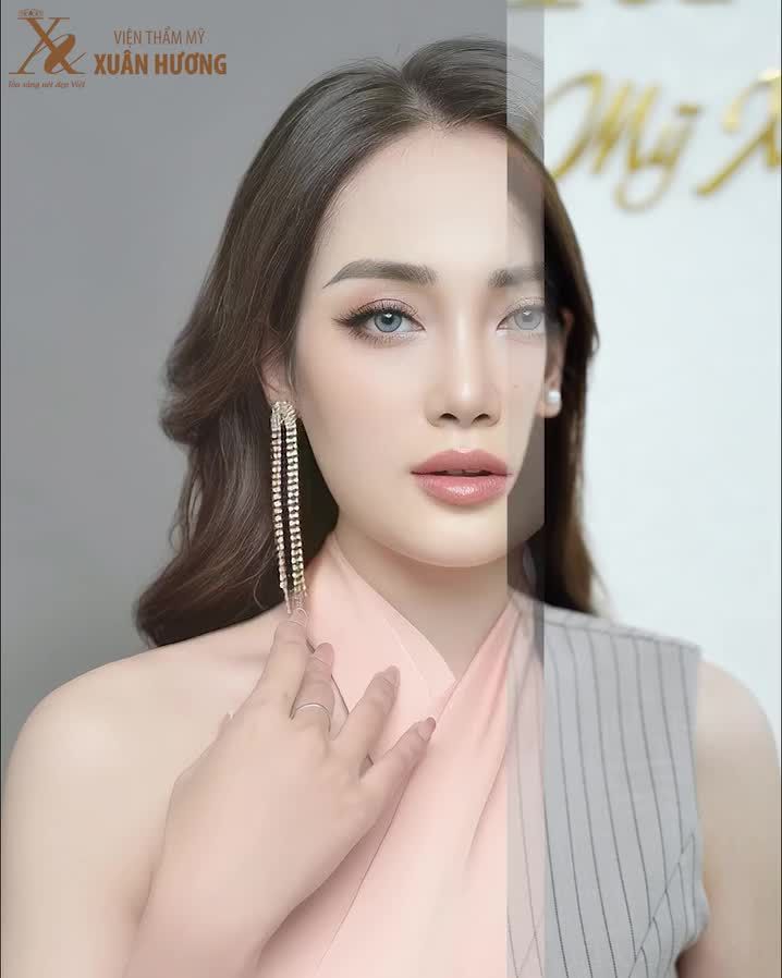 Chủ tịch Xuân Hương thực hiện trẻ hóa da nâng cơ Thermage 4.0