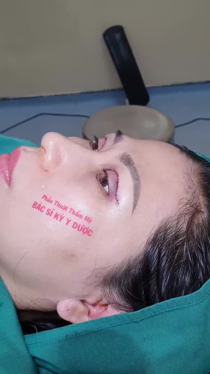 Chị khách tới trung tâm với đôi mắt 1 mí không đồng đều, da dư che nếp mí. Đặc điểm này khiến chị trông đứng tuổi hơn nhiều.