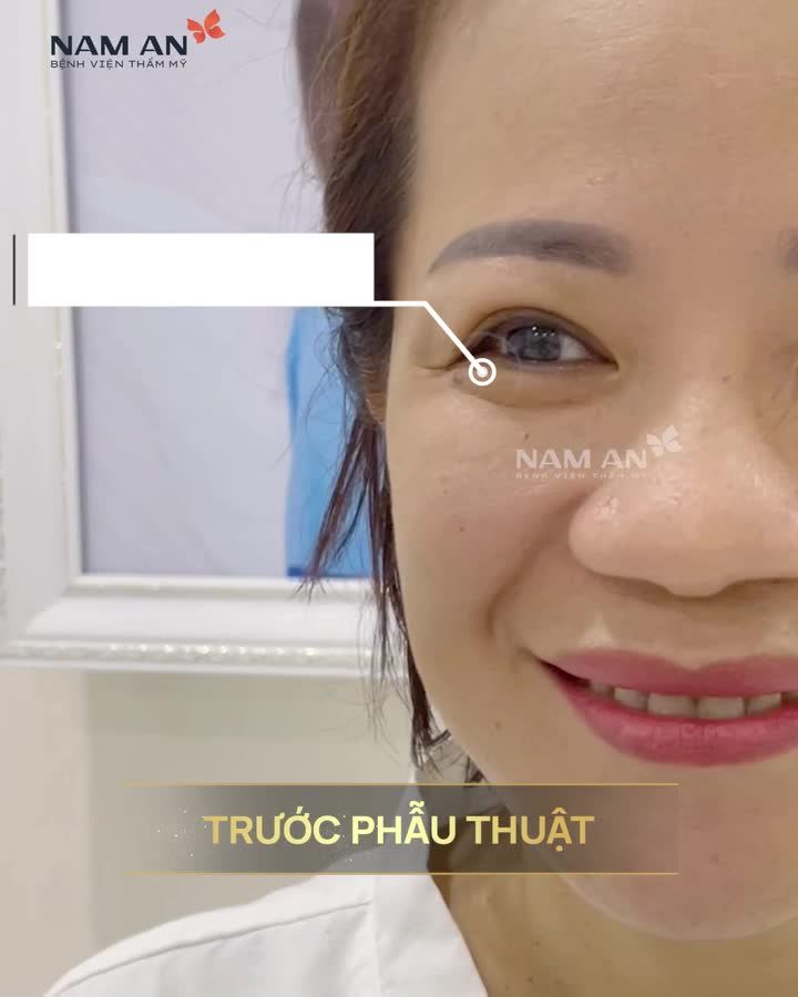 NÂNG CUNG CHÂN MÀY TRẺ HÓA ĐÔI MẮT