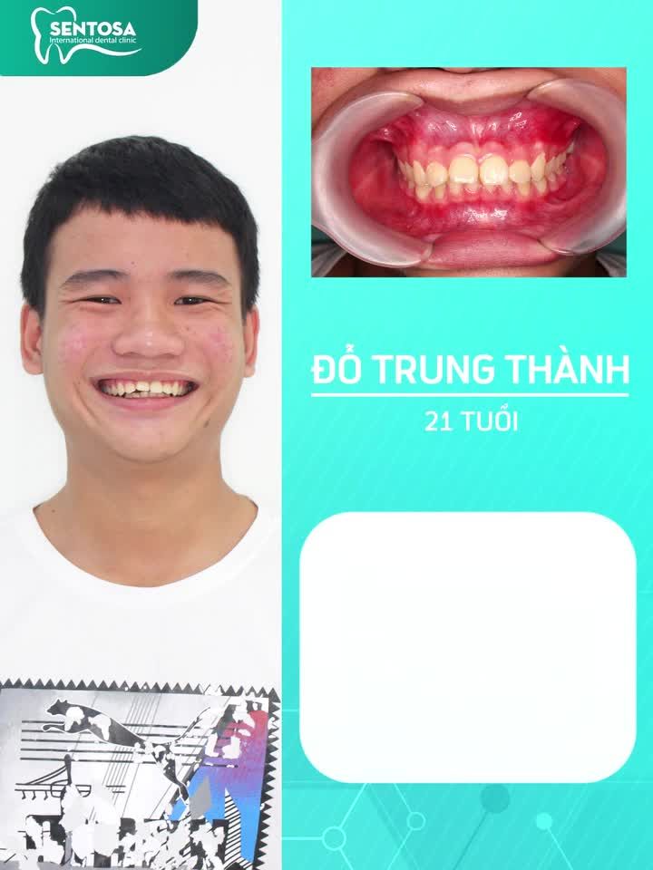 HÀNH TRÌNH NIỀNG RĂNG TRONG 2 NĂM TRỌN GÓI TỪ 16 TRIỆU BIẾT TRƯỚC KẾT QUẢ NIỀNG SAU 2 PHÚT
