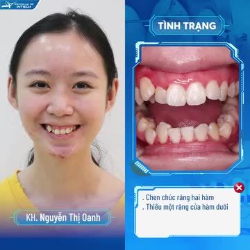 CÔ GÁI LẶN LỘI TỪ HẢI DƯƠNG LÊN HÀ NỘI NIỀNG RĂNG ĐỂ CHẤM DỨT TÌNH TRẠNG MỎI HÀM KHI ĂN NHAI DO HÀM RĂNG CHEN CHÚC NẶNG