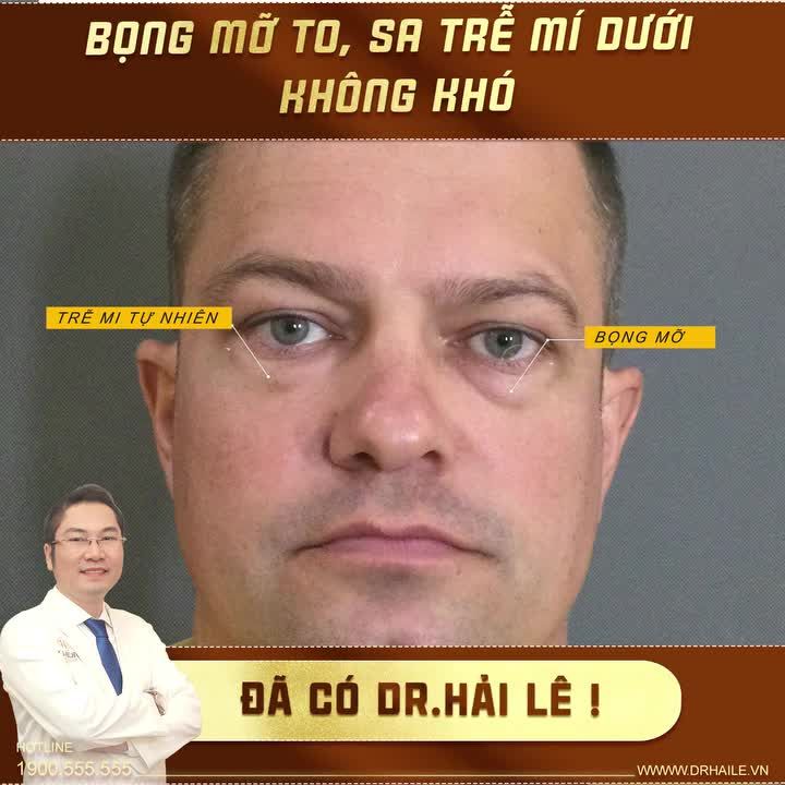 Trước khi đến với Dr.Hải Lê, vị khách hàng gặp phải tình trạng mí dưới sa trễ, bọng m.ỡ to, vừa ảnh hưởng đến yếu tố thẩm mỹ, vừa ảnh hưởng đến sức khỏe đôi mắt.