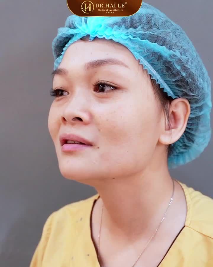 Thay dáng mũi, đổi vận số  Đây chính là mong muốn của vị khách hàng khi thực hiện Nâng mũi tại Dr.Hải Lê!