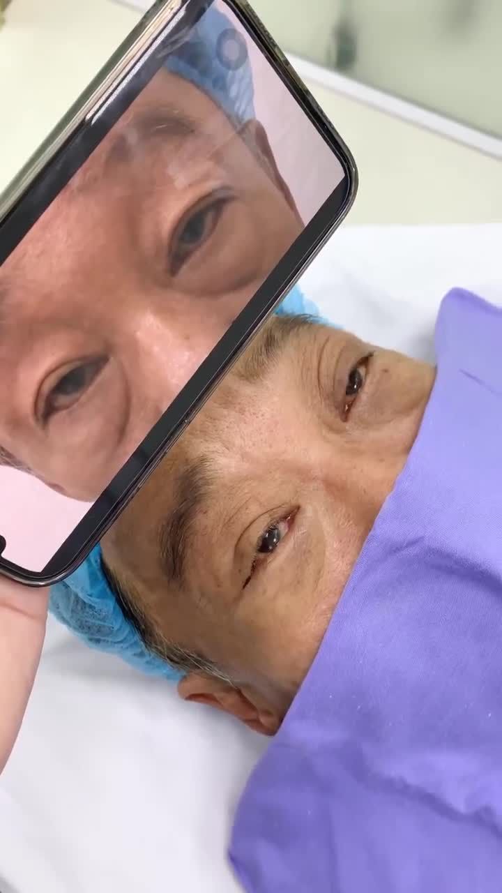 Xử lý bọng mỡ dưới nhẹ nhàng không lộ dấu vết thẩm mỹ chỉ sau 20 phút