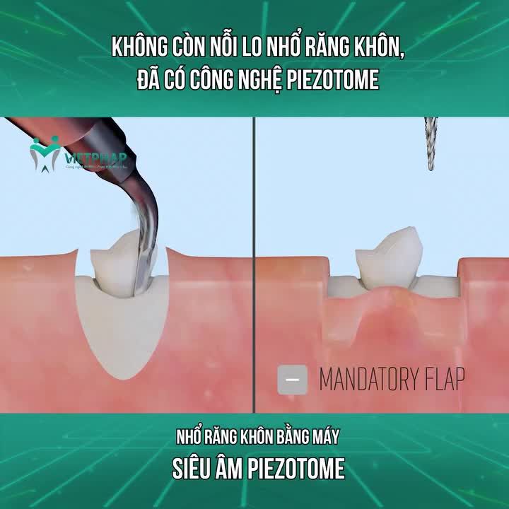 NHỔ RĂNG KHÔN KHÔNG ĐAU BẰNG MÁY PIEZOTOME
