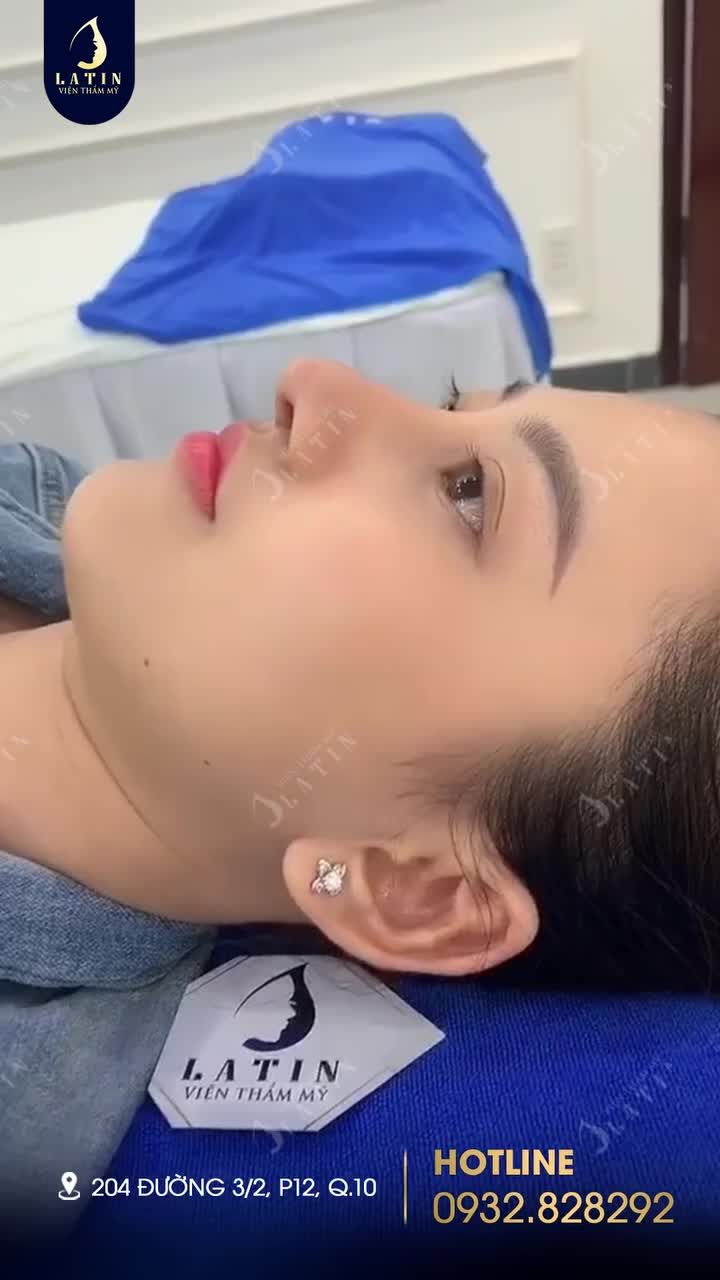 Mũi cấu trúc sụn sườn 3 tuần tuổi đẹp tự nhiên theo đúng mong muốn của em gái