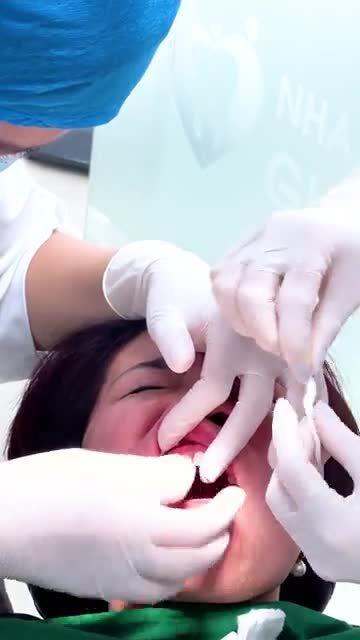 THẨM MỸ 22 RĂNG SỨ CHO CHỊ KHÁCH HÀNG ĐẾN TỪ HÀ GIANG
