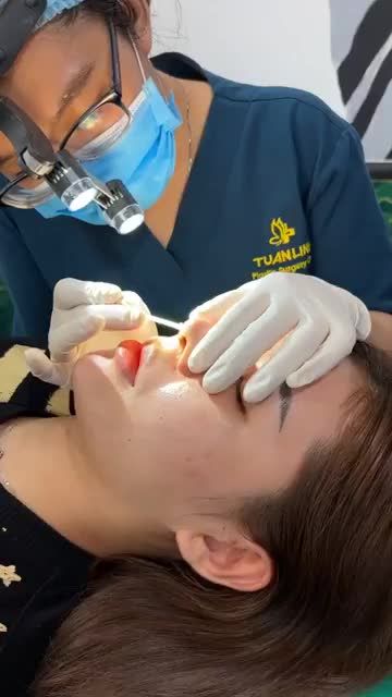 Case mũi cấu trúc sau 10 ngày
