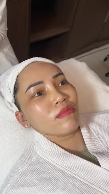 CẬN CẢNH quá trình LASER TRẺ HÓA DA 3S PLUS cho chị khách yêu nhà JW