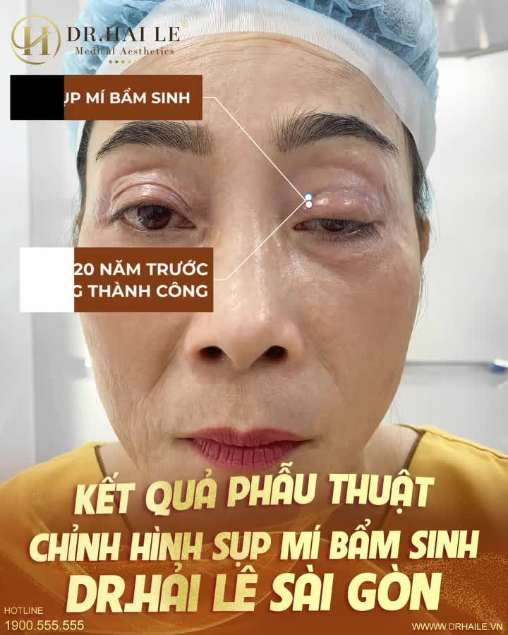 PHẪU THUẬT CHỈNH HÌNH SỤP MÍ BẨM SINH DR.HẢI LÊ SÀI GÒN - SỞ HỮU ĐÔI MẮT TỰ TIN SAU 20 NĂM