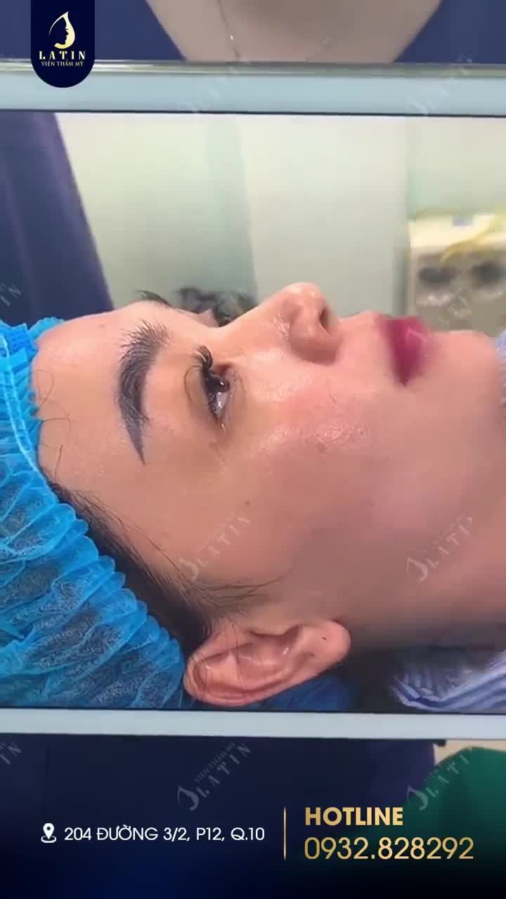 MŨI CẤU TRÚC VỪA HOÀN THÀNH CHO BẠN GÁI ĐẾN TỪ QUẢNG NGÃI