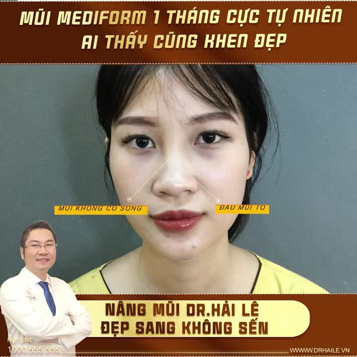 Trước khi thực hiện Nâng mũi tại Dr.Hải Lê, vị khách hàng sở hữu dáng mũi nhiều khuyết điểm