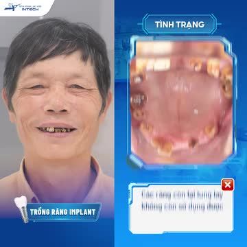 10 NĂM MẤT RĂNG KHÔNG THỂ ĂN NHAI , U60 VỠ ÒA HẠNH PHÚC SAU KHI TRỒNG IMPLANT TOÀN HAI HÀM
