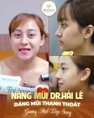 Chiếc mũi thanh tú, hài hòa sẽ đem tới cho gương mặt của bạn đường nét mềm mại, quyến rũ mà không gì có thể thay thế được!