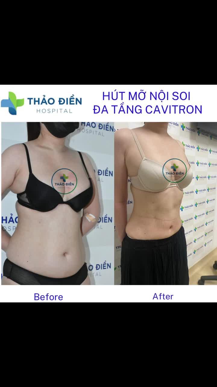 HÚT MỠ NỘI SOI ĐA TẦNG CÔNG NGHỆ CAVITRON