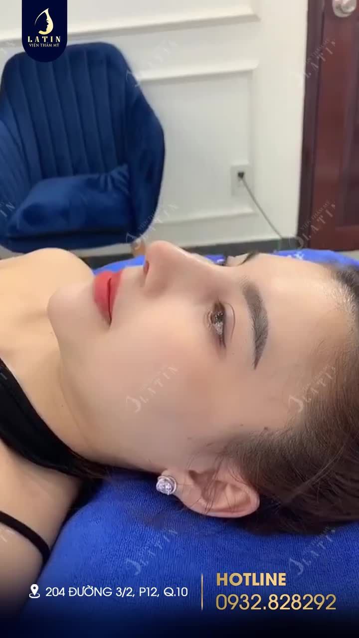 Mũi cấu trúc sửa lại sau 10 ngày...Dáng cao tây cho em khách cực xinh