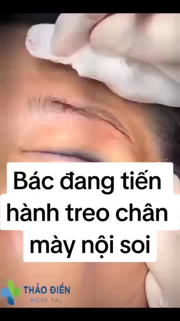 Bạn đã nghe và tìm hiểu phương pháp nâng cung chân mày nhưng chưa bao giờ nghe nâng chân mày nội soi???