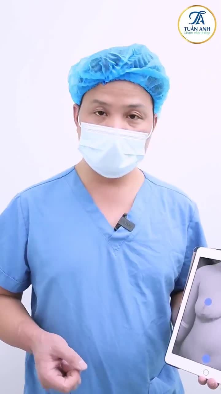 Chị khách hàng hôm nay đến với Bác sĩ Tuấn Anh đã thu gọn ngực phì đại và treo sa trễ ở nơi khác, ngực bị tình trạng sẹo mỏ neo lồi lõm, xấu, thâm, núm v.ú tụt.
