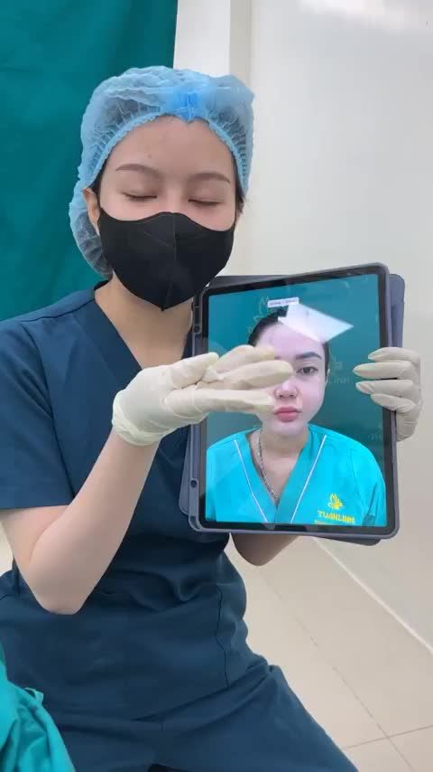 Case mũi cấu trúc sửa lại vừa hoàn thành