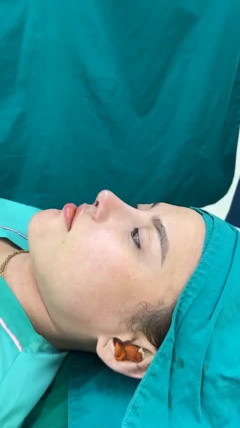 Case mũi cấu trúc sửa lại vừa hoàn thành